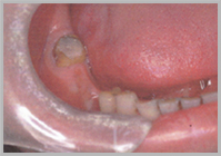 下顎臼歯部写真1