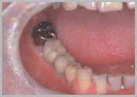 下顎臼歯部写真2