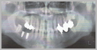 下顎臼歯部写真3