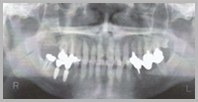 下顎臼歯部写真4