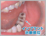 左下顎奥歯写真3